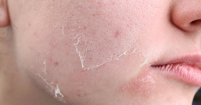 How to Take Care of Dry Skin in Winter? - Pnk Beauty