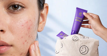acne in summer and how to prevent it