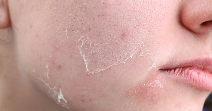 how to take care of dry skin in winter