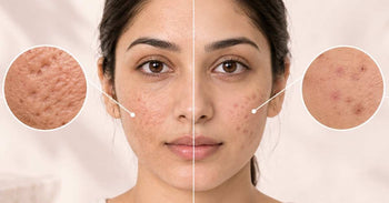 acne scars vs marks difference on skin