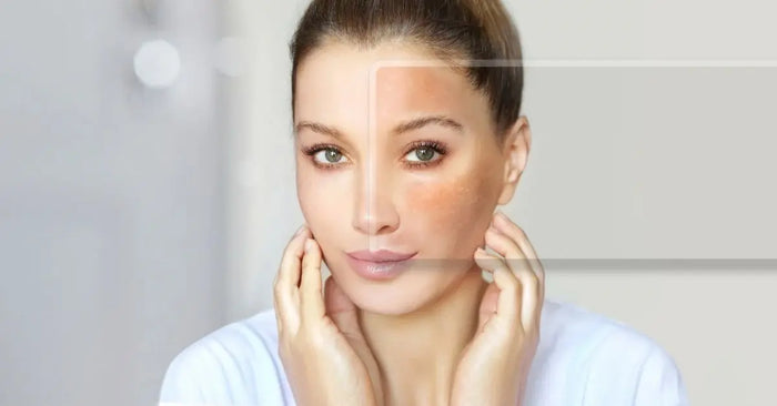 Key Ingredients That Help Calm Facial Redness (and How They Work) - Pnk Beauty
