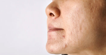 Why Does Pigmentation Appear on the Face? Causes, Types & Dermatologist-Approved Solutions - Pnk Beauty