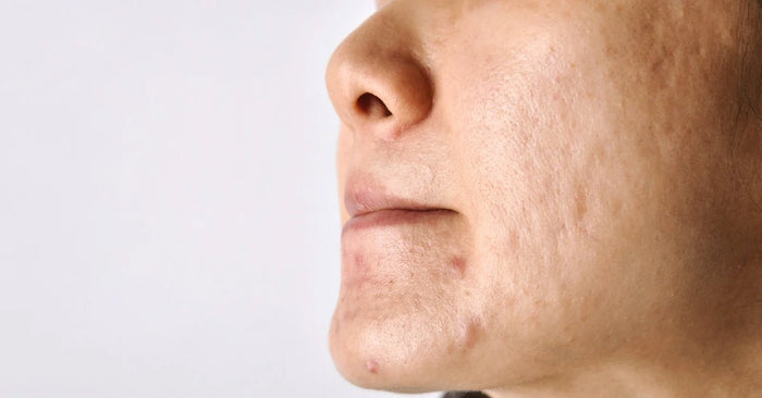 Why Does Pigmentation Appear on the Face? Causes, Types & Dermatologist-Approved Solutions - Pnk Beauty