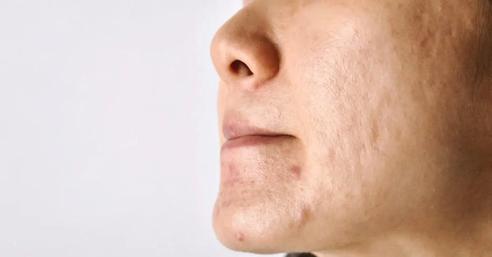 Why Does Pigmentation Appear on the Face? Causes, Types & Dermatologist-Approved Solutions - Pnk Beauty
