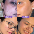 Evoaked Acne Series – Salicylic Acid Face Serum