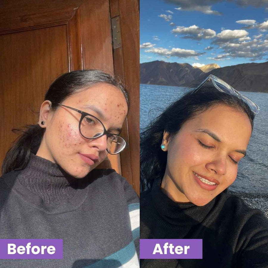 Evoaked Acne Series – Travel Acne Control Combo